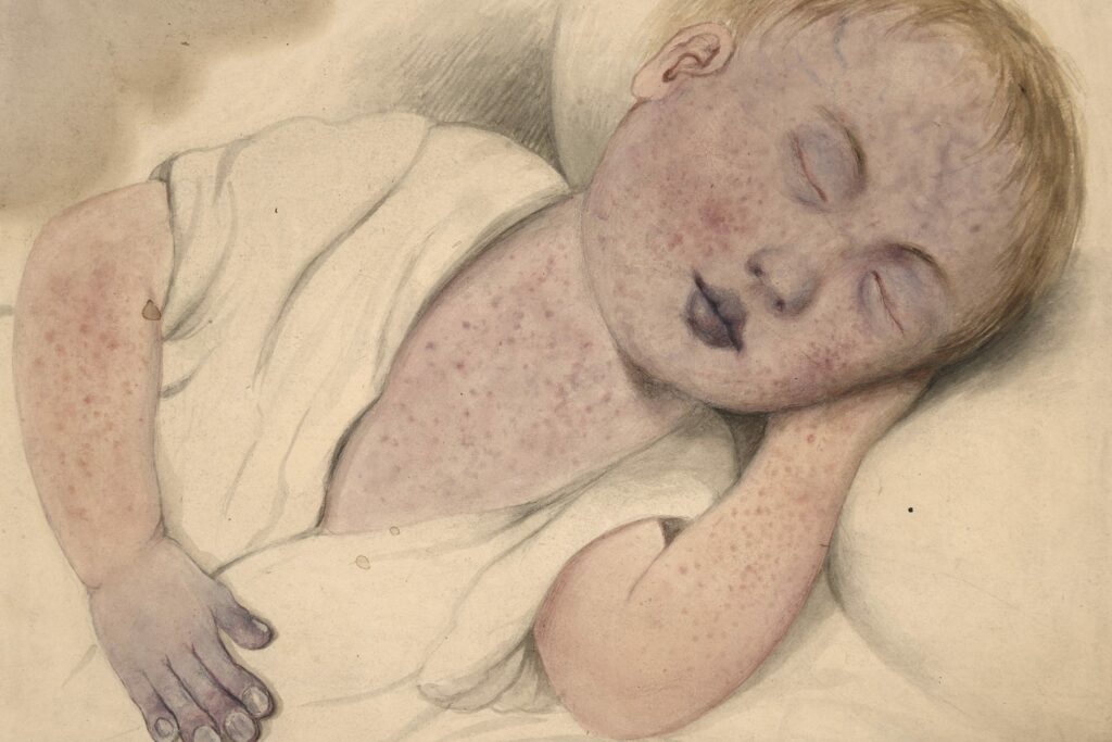 measles