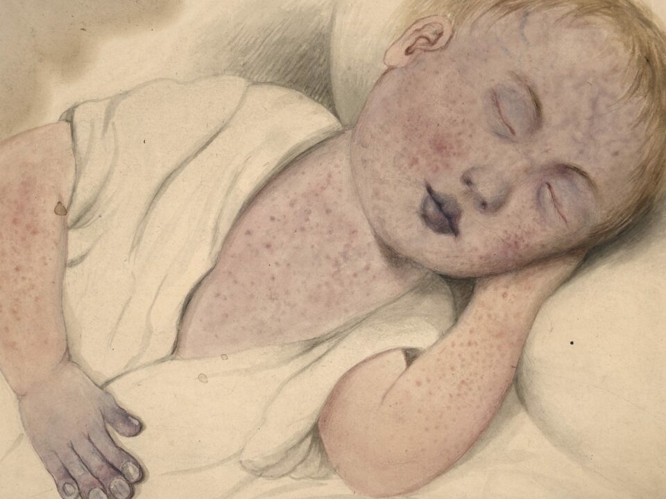 measles