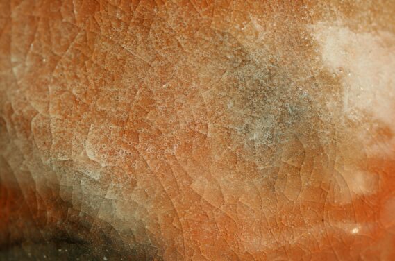 Skin, Melanom