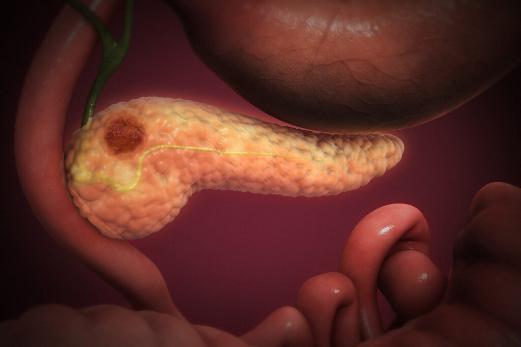 Pancreatic Cancer