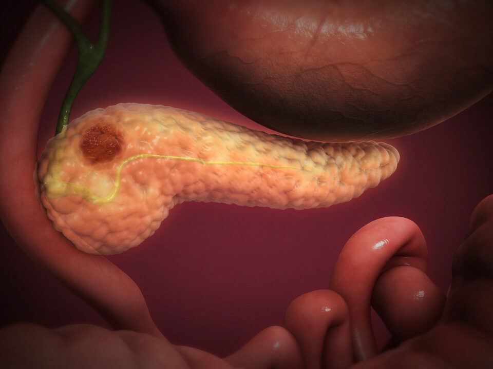 Pancreatic Cancer