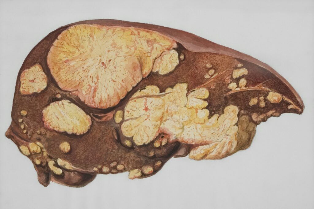 Hepatitis