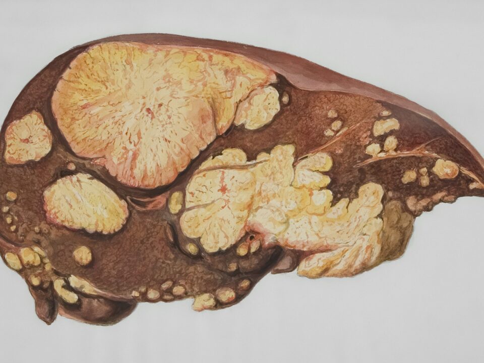 Hepatitis