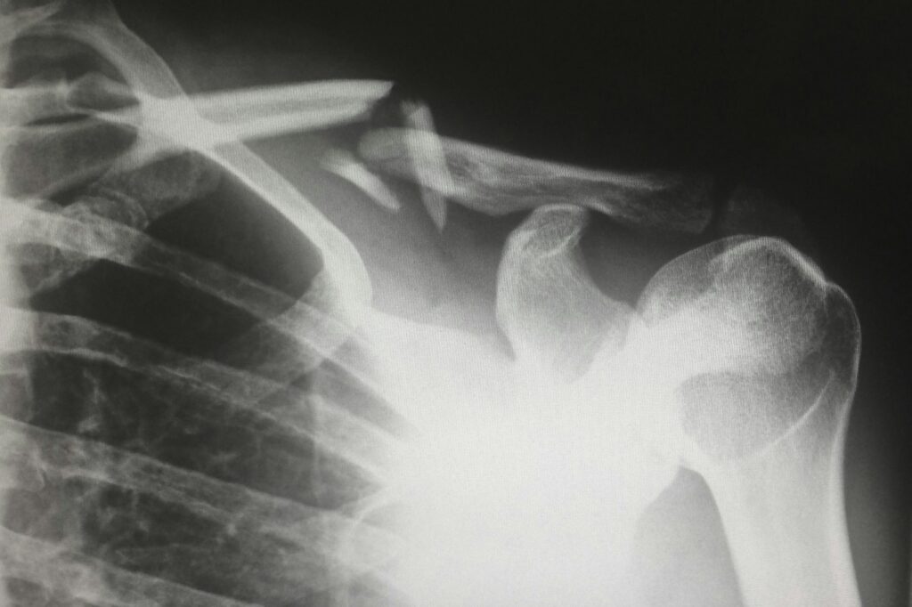fracture