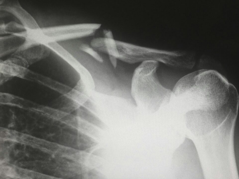 fracture