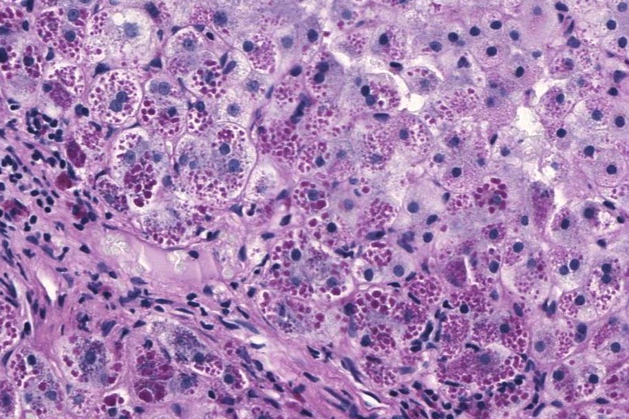 Alpha-1-Antitrypsin