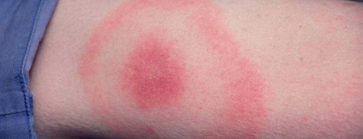 Lyme disease