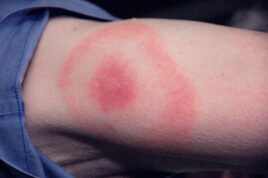 Lyme disease