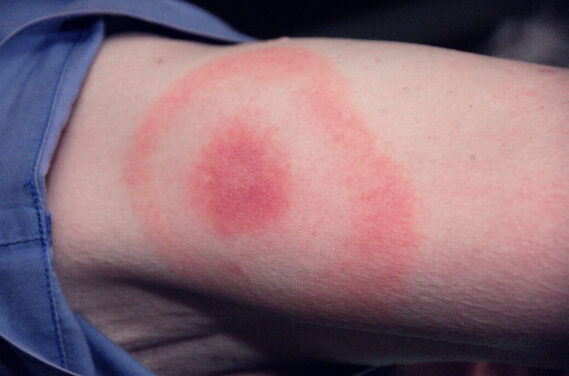 Lyme disease