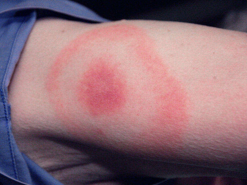 Lyme disease