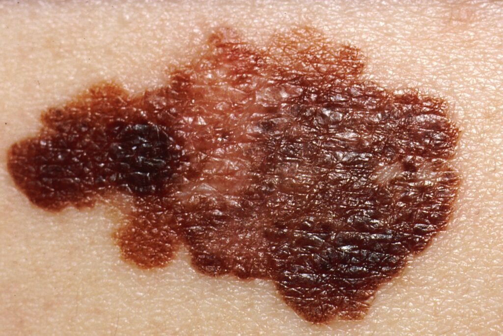 Melanoma
