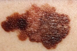 Melanoma