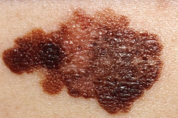 Melanoma