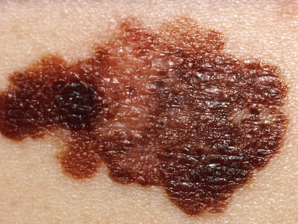 Melanoma