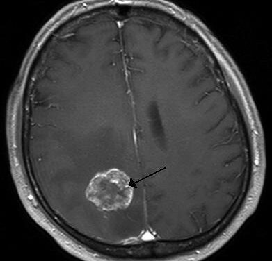 Hirnmetastase