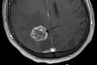 Hirnmetastase