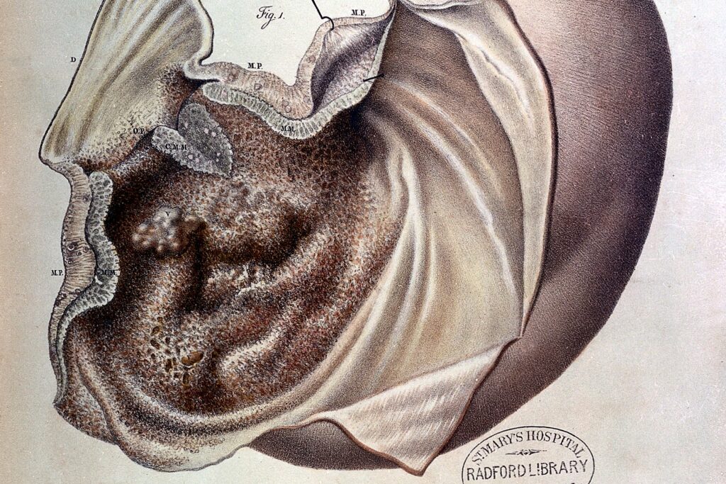 Stomach cancer