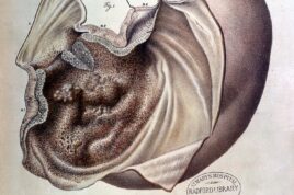 Stomach cancer