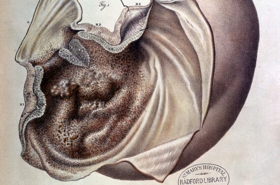 Stomach cancer