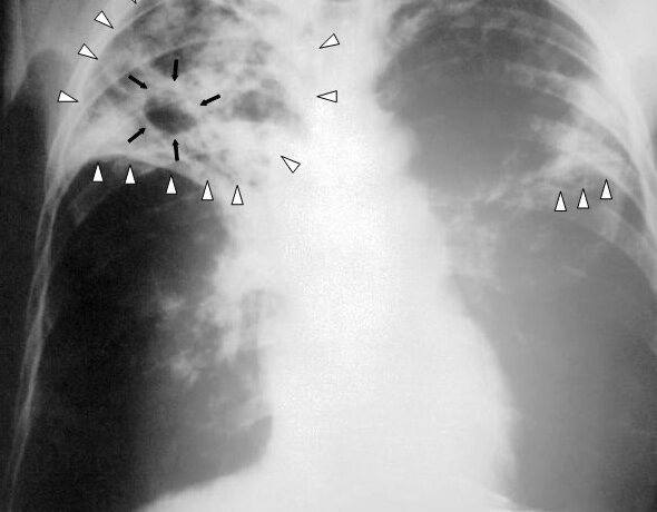Tuberculosis