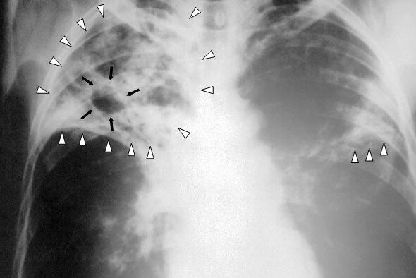 Tuberculosis