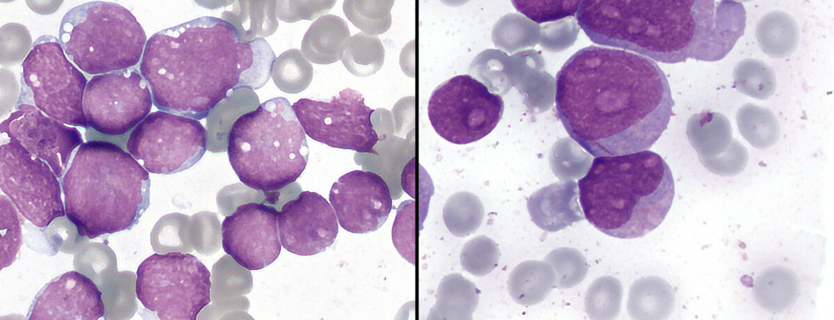 Leukemia
