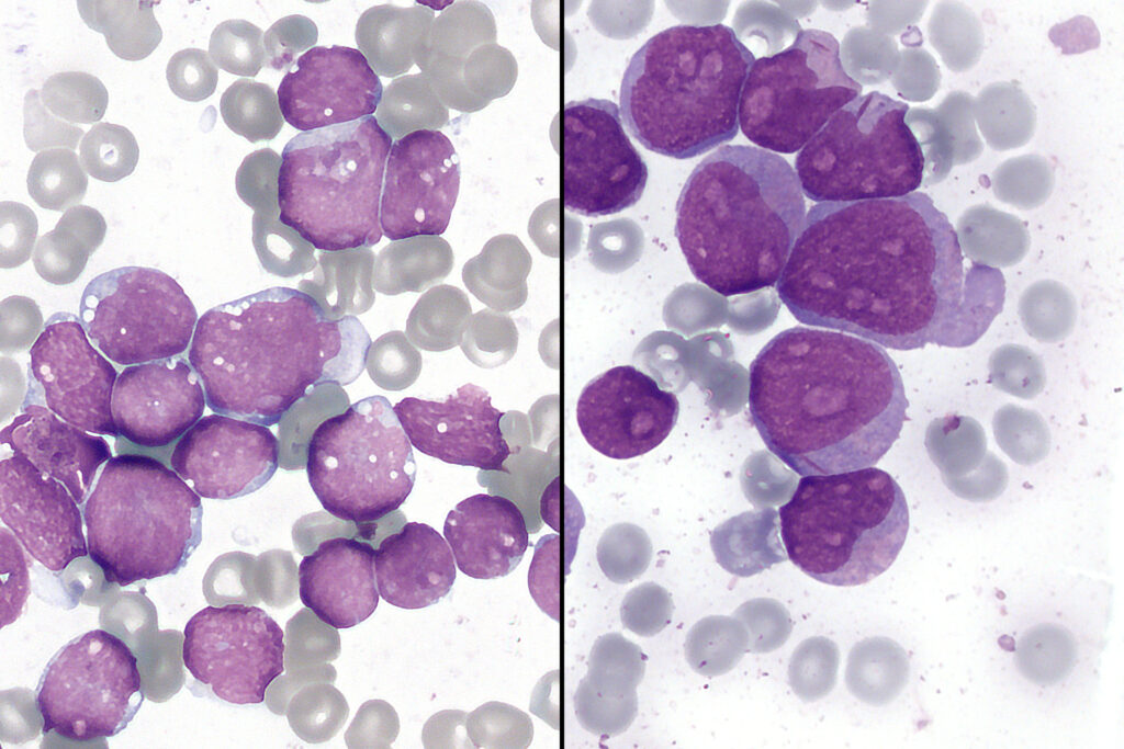 Leukemia