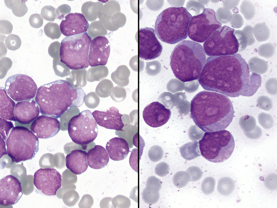 Leukemia