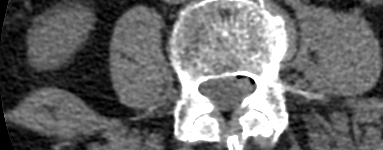 atherosclerosis
