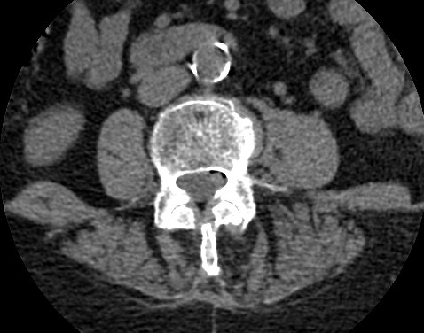 atherosclerosis