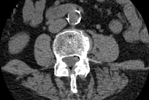 atherosclerosis