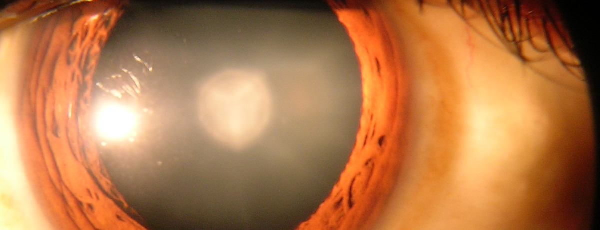 Cataract