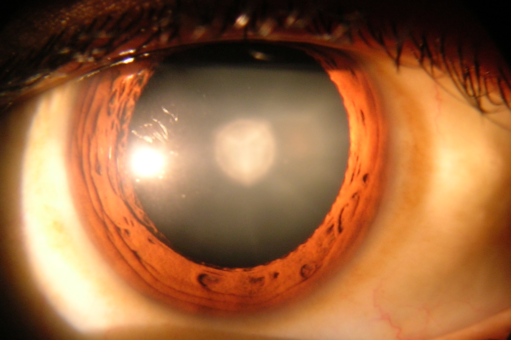 Cataract