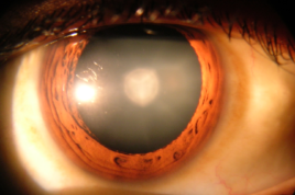 Cataract