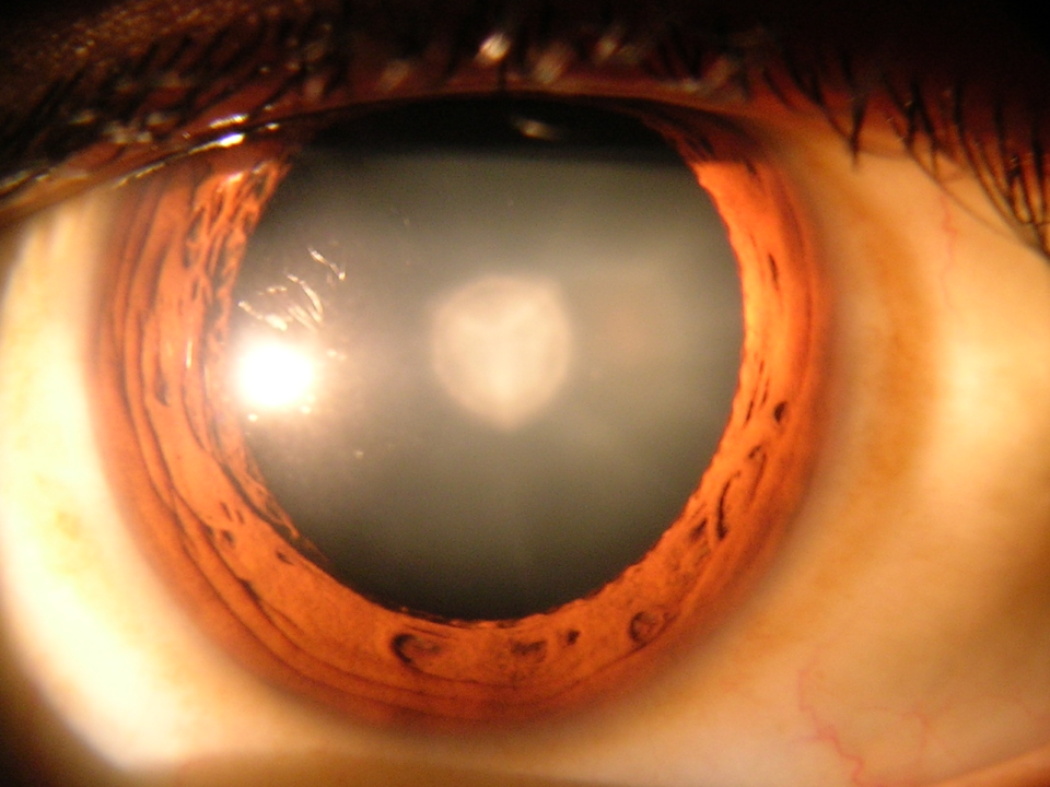 Cataract